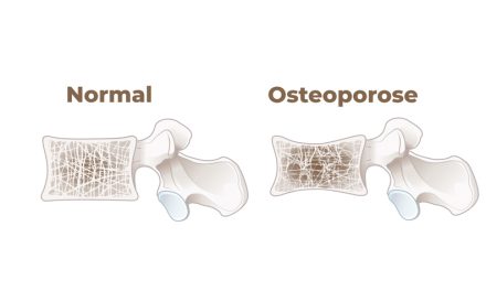 Pflanzenbasiert = Osteoporose-Risiko?