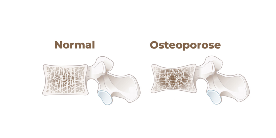 Pflanzenbasiert = Osteoporose-Risiko?